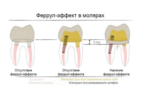 Переосмысление феррула – новый подход к старой дилемме